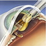 Cataractă